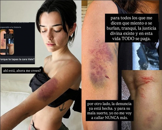 Escándalo en Boca con Riquelme por romances y violencia 5 VALEN SALCEDO MOSTRO LOS MORETONES QUE LE QUEDARON TRAS SER AGREDIDA