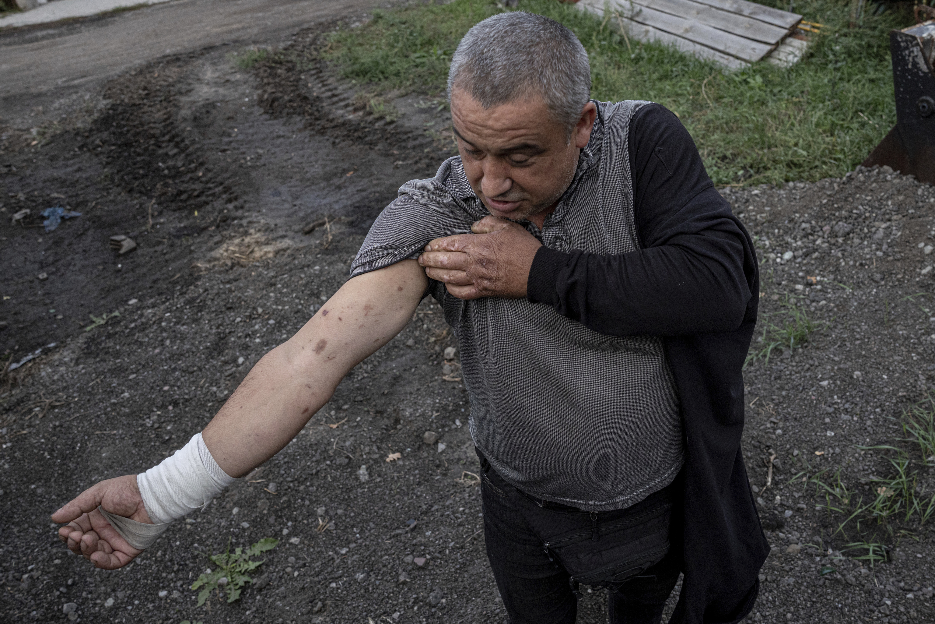 Járkiv sufre ataques con drones FPV 2 Oleg Zarychanskyi muestra sus heridas por ataque de dron.